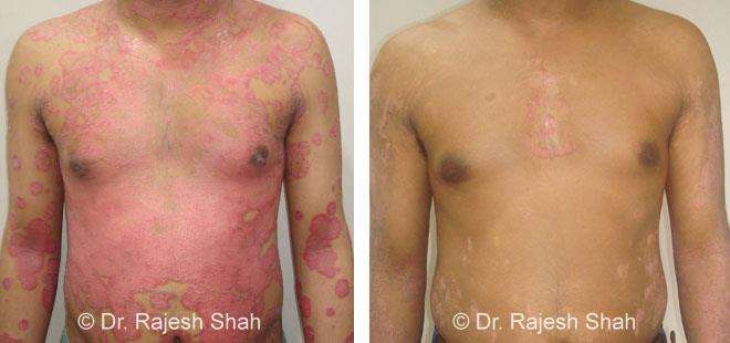 Psoriasis Before and After Case Photo