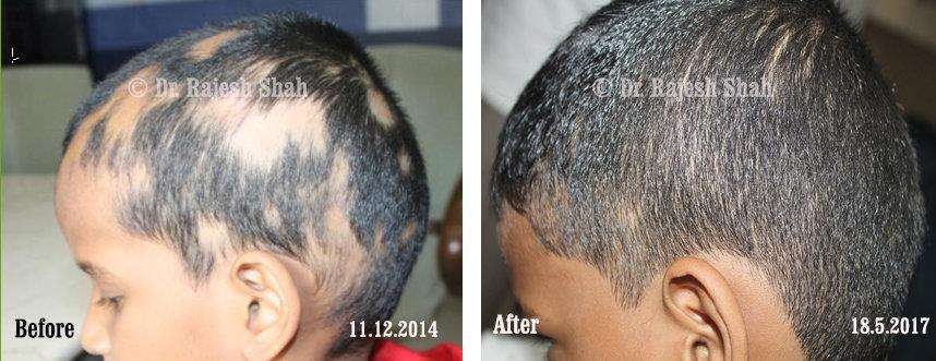 Alopecia Areata Before and After Case Photo