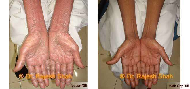 Psoriasis Before and After Case Photo