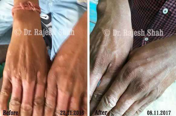 Psoriasis Before and After Case Photo