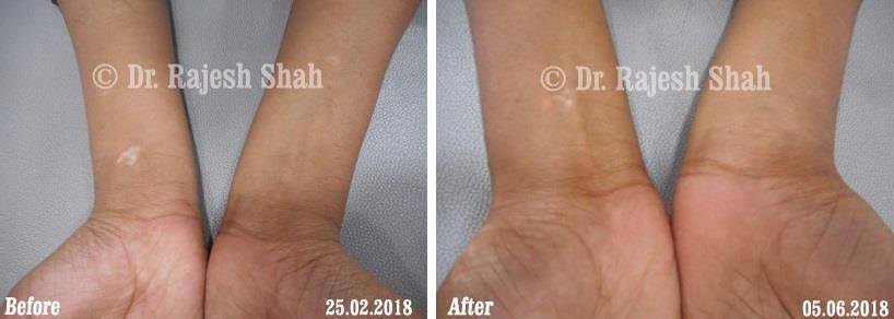 Vitiligo Before and After Case Photo