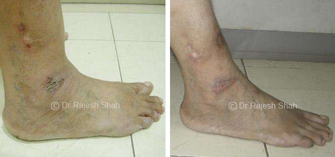 Psoriasis Before and After Case Photo