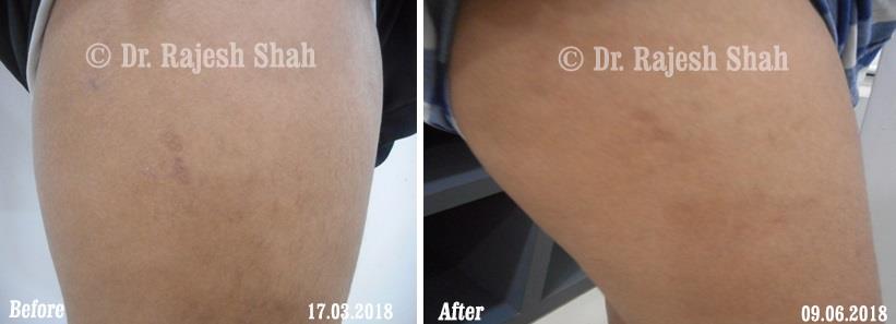 Alopecia Areata Before and After Case Photo