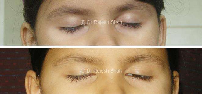 Vitiligo Before and After Case Photo