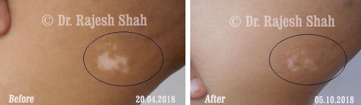 Vitiligo Before and After Case Photo