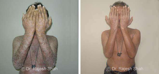Psoriasis Before and After Case Photo