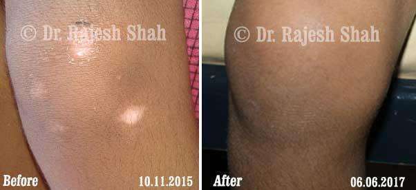Vitiligo Before and After Case Photo