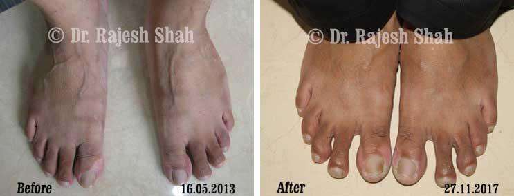 Vitiligo Before and After Case Photo