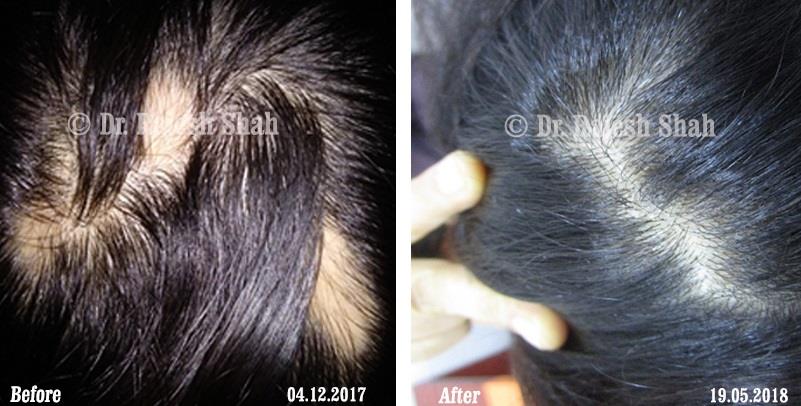 Alopecia Areata Before and After Case Photo