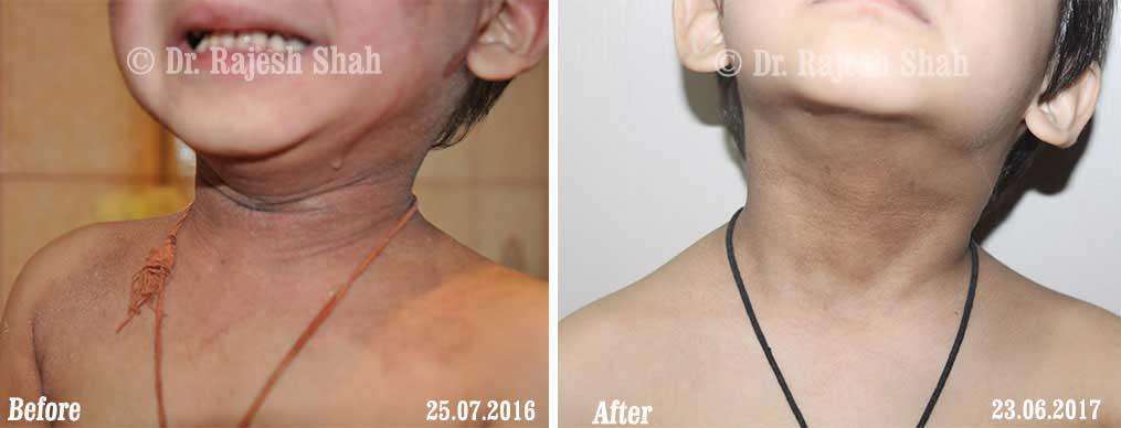 Eczema Before and After Case Photo