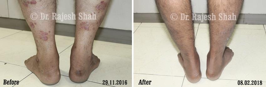 Psoriasis Before and After Case Photo