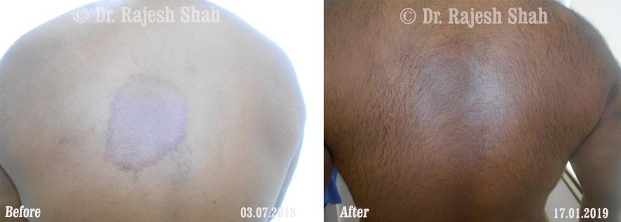 Psoriasis Before and After Case Photo