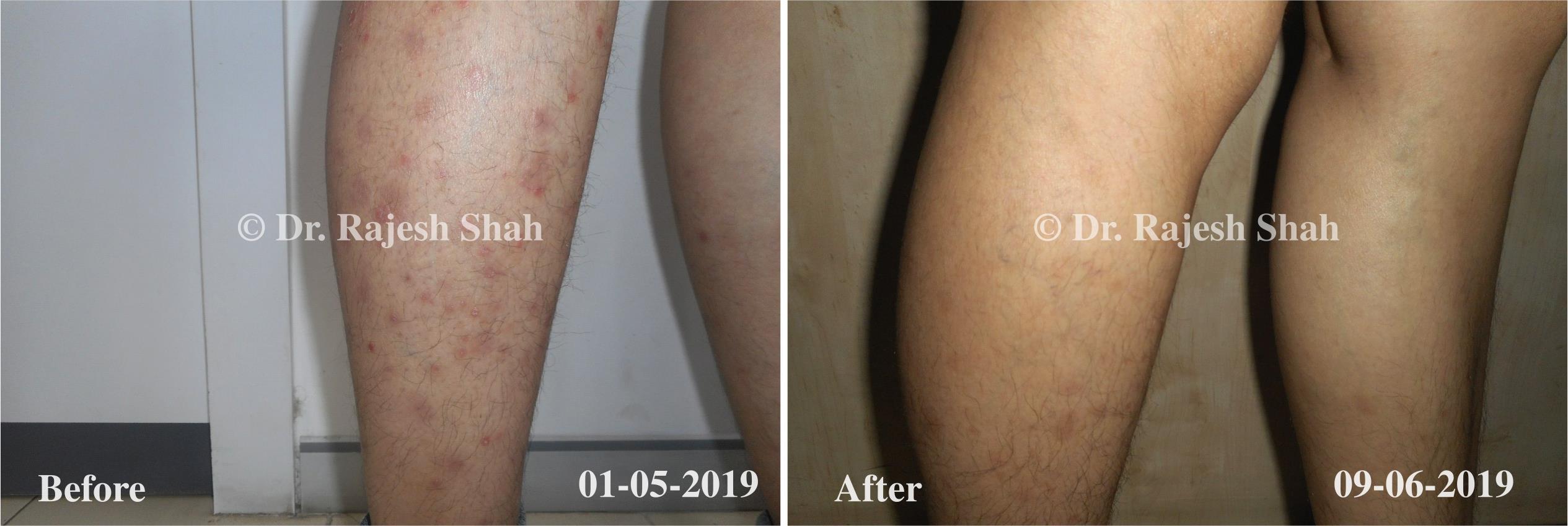 Psoriasis Before and After Case Photo