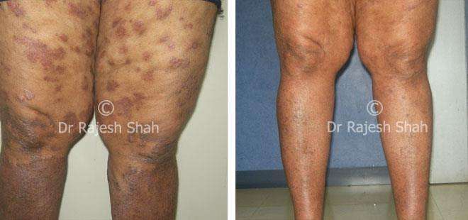 Psoriasis Before and After Case Photo