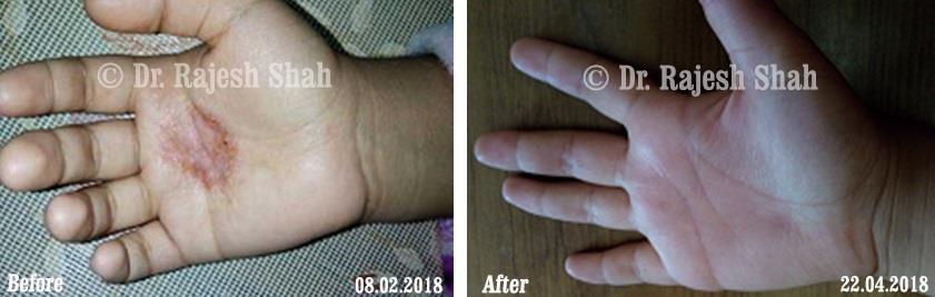 Eczema Before and After Case Photo