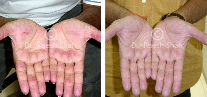 Eczema Before and After Case Photo