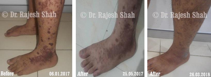 Lichen Planus Before and After Case Photo