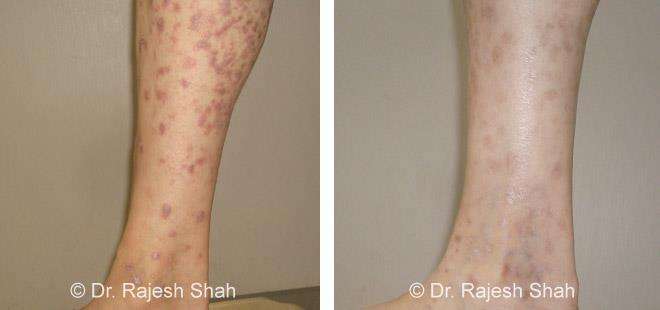 Lichen Planus Before and After Case Photo