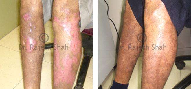 Psoriasis Before and After Case Photo