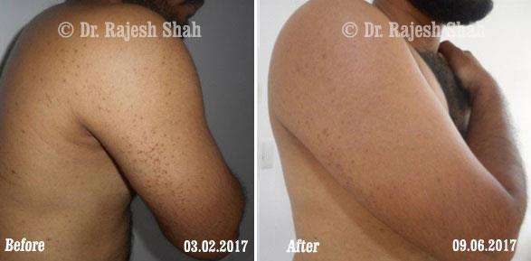 Lichen Planus Before and After Case Photo