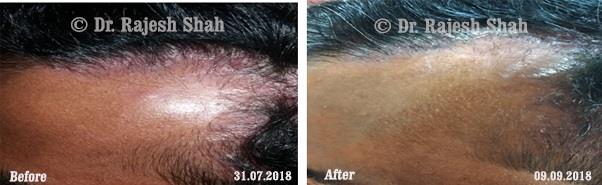 Psoriasis Before and After Case Photo