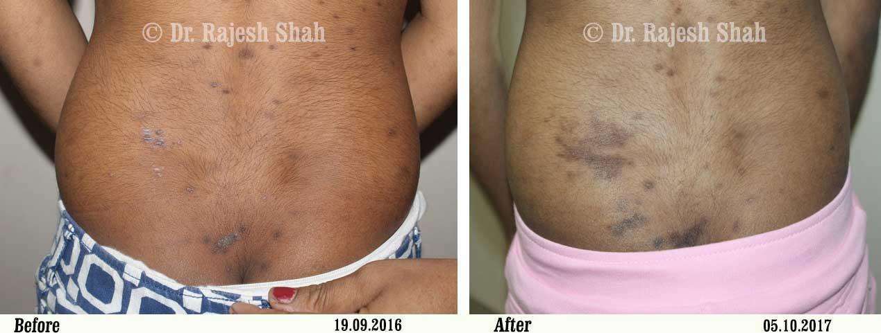 Lichen Planus Before and After Case Photo