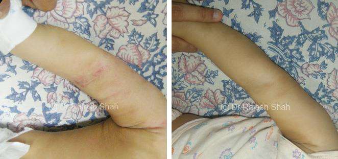 Atopic Dermatitis Before and After Case Photo