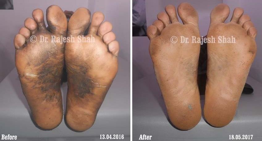 Psoriasis Before and After Case Photo