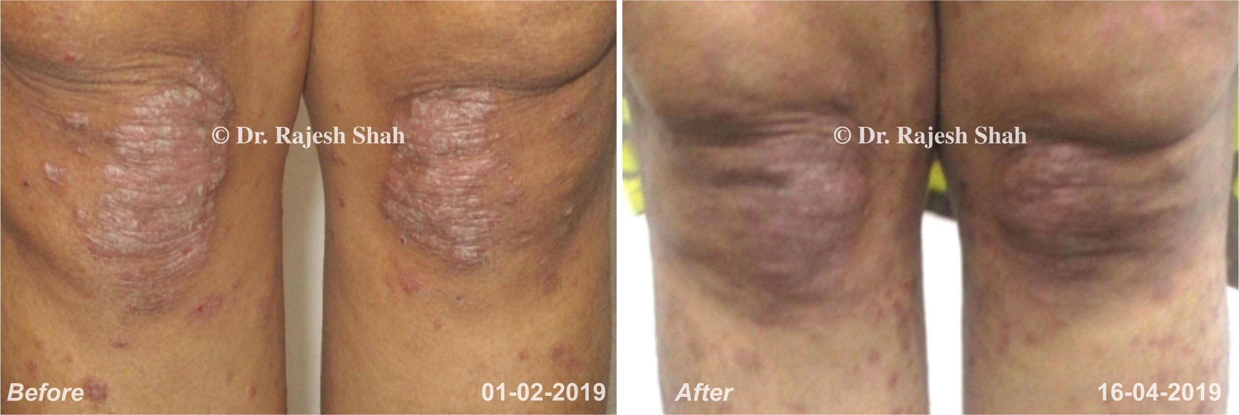 Psoriasis Before and After Case Photo