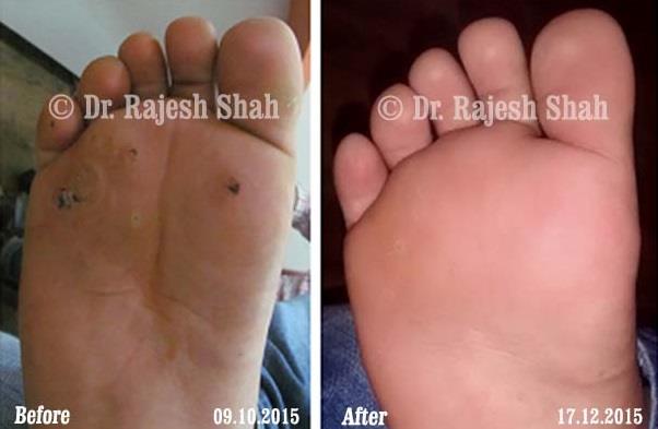 Corns (Callosities) Before and After Case Photo