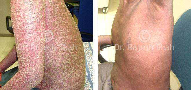 Psoriasis Before and After Case Photo