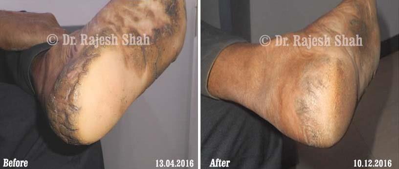 Psoriasis Before and After Case Photo