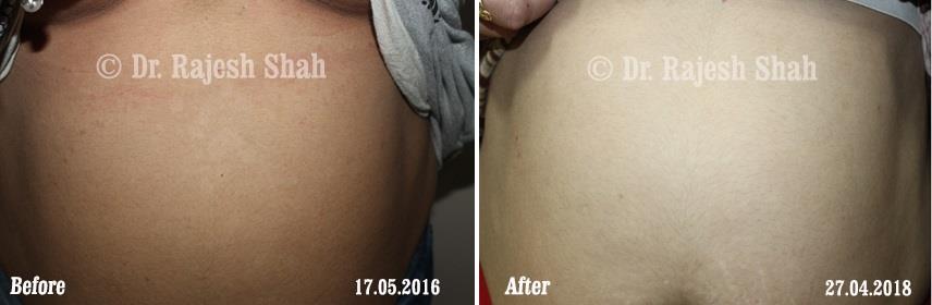 Pityriasis Versicolor