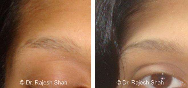 Alopecia Areata Before and After Case Photo