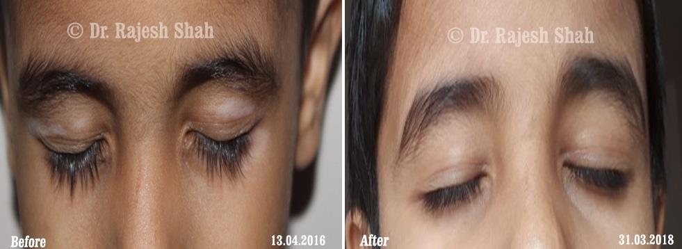 Vitiligo Before and After Case Photo