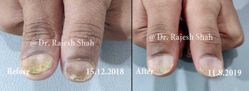 Psoriasis Before and After Case Photo