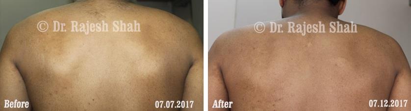 Pityriasis Versicolor Before and After Case Photo