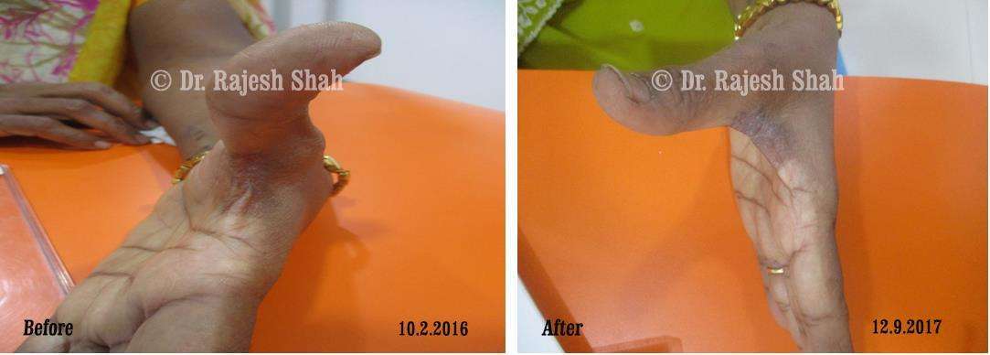 Hypertension Before and After Case Photo