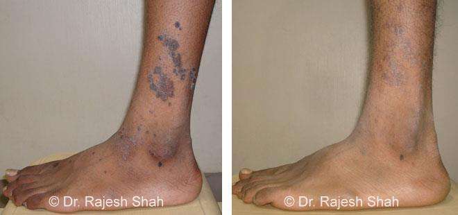 Lichen Planus Before and After Case Photo