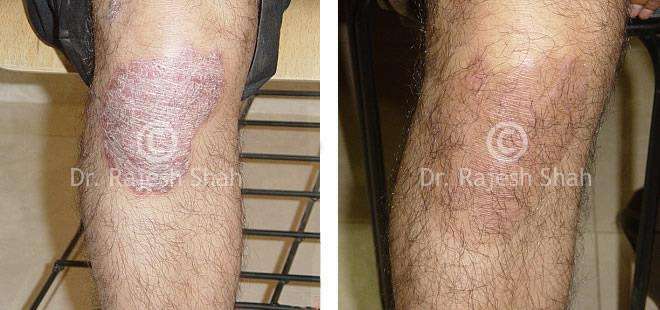 Psoriasis Before and After Case Photo