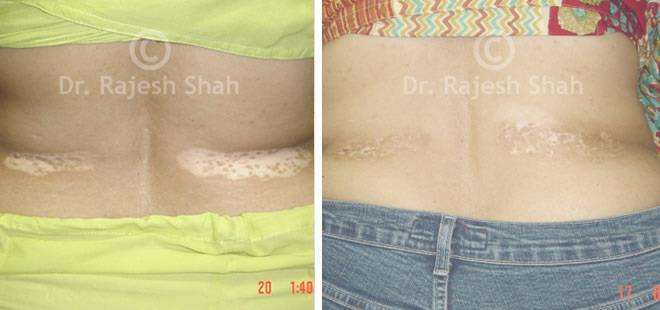 Vitiligo Before and After Case Photo