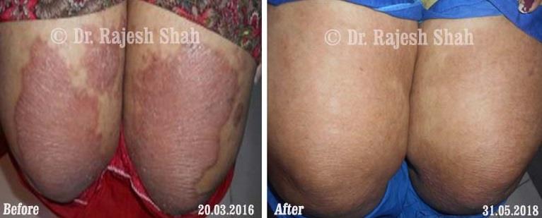 Psoriasis Before and After Case Photo