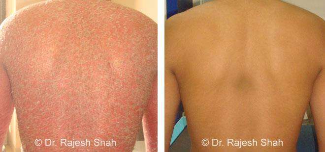 Psoriasis Before and After Case Photo