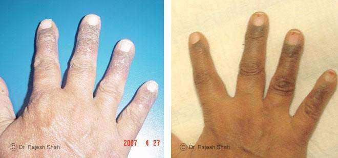 Eczema Before and After Case Photo