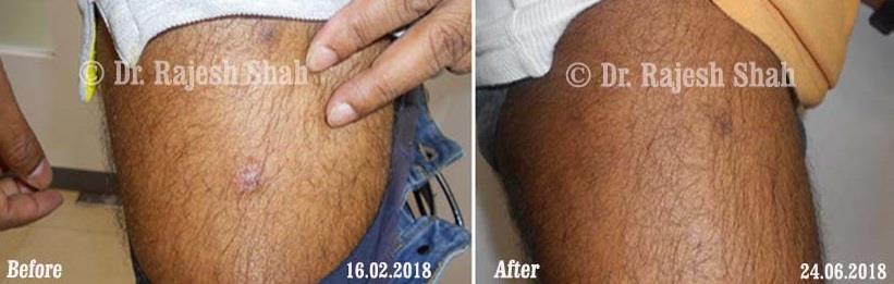 Psoriasis Before and After Case Photo