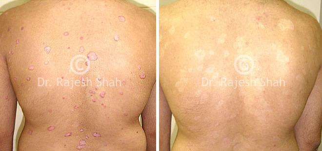 Psoriasis Before and After Case Photo