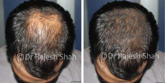 Alopecia Areata