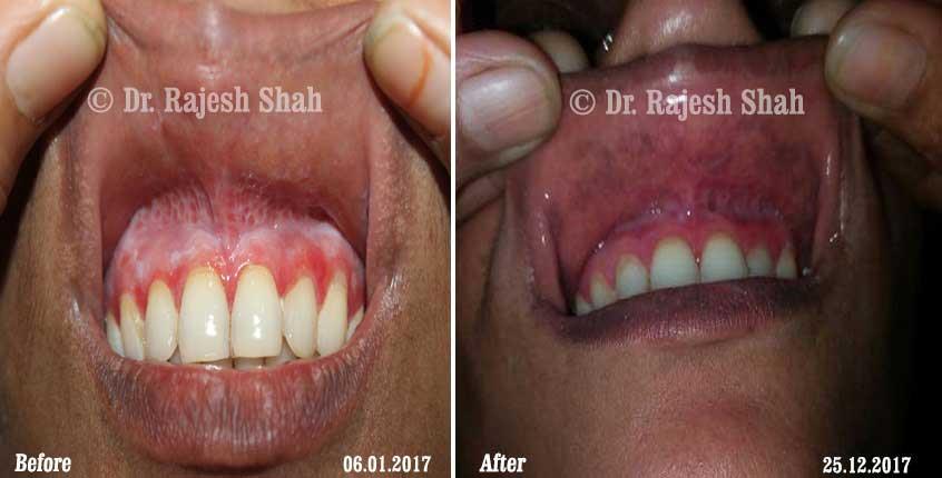Lichen Planus Before and After Case Photo