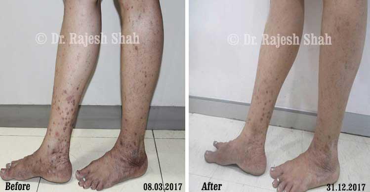 Lichen Planus Before and After Case Photo