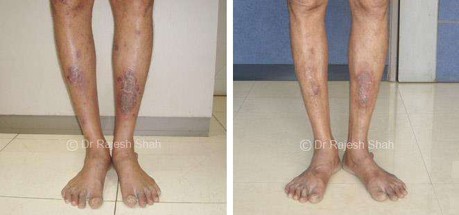 Lichen Planus Before and After Case Photo